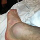 Illustration for article titled In Which Sport Can You Win Despite This Grotesquely Swollen Ankle?